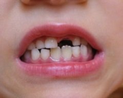 Süt dişleri neden önemlidir ?