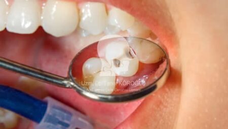 Diş çürüğü tedavisi