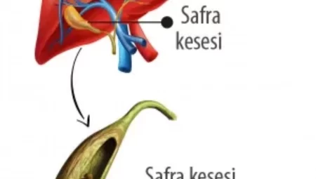Safra kesesi taşının tedavi yöntemi cerrahidir!